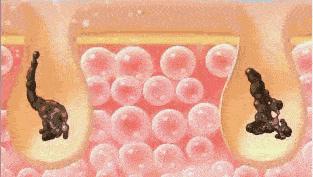 如何从根本上解决黑头问题,黑头太顽固教你去黑头的方法