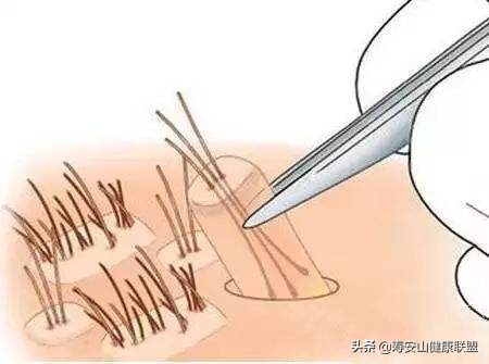 头发少是植发还是接发比较好看,植发与织发的区别