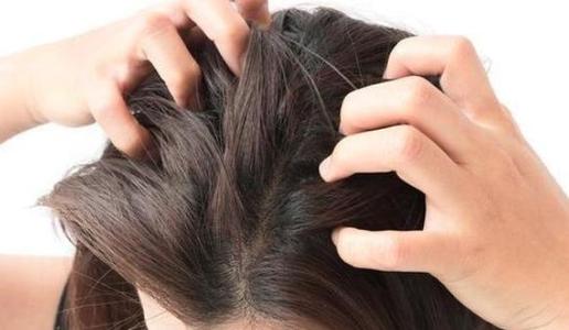 头皮上抠出白皮是头皮屑吗,头皮屑白泥是什么