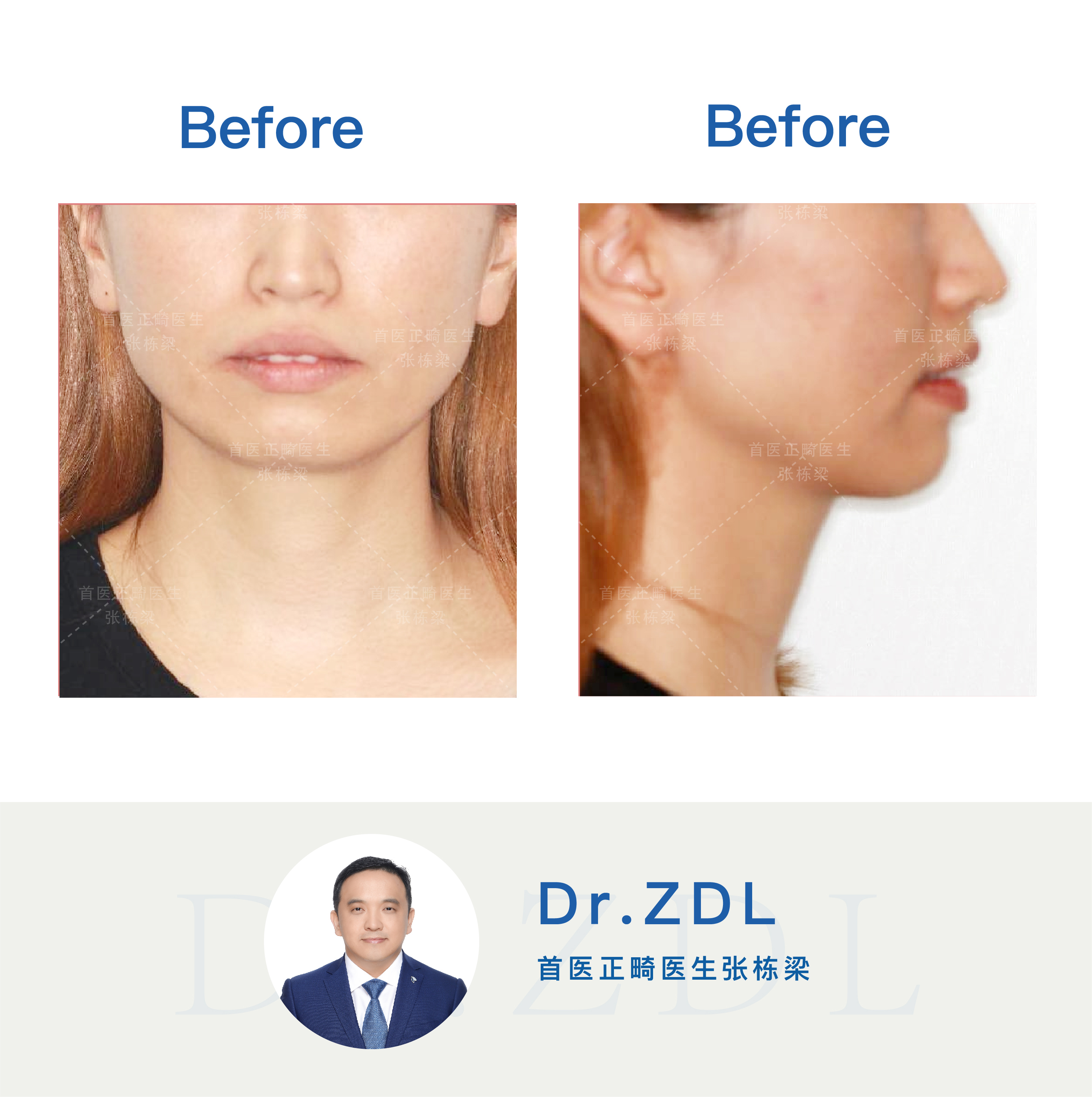 嘴突不做牙齿矫正后果,嘴突没有龅牙可以修复吗