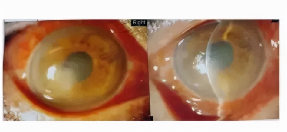 异物感角膜炎,外伤性角膜炎会导致失明吗