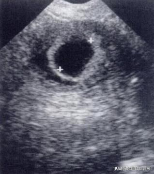 3毫米卵黄囊未见胎芽正常么,40多天的卵黄囊