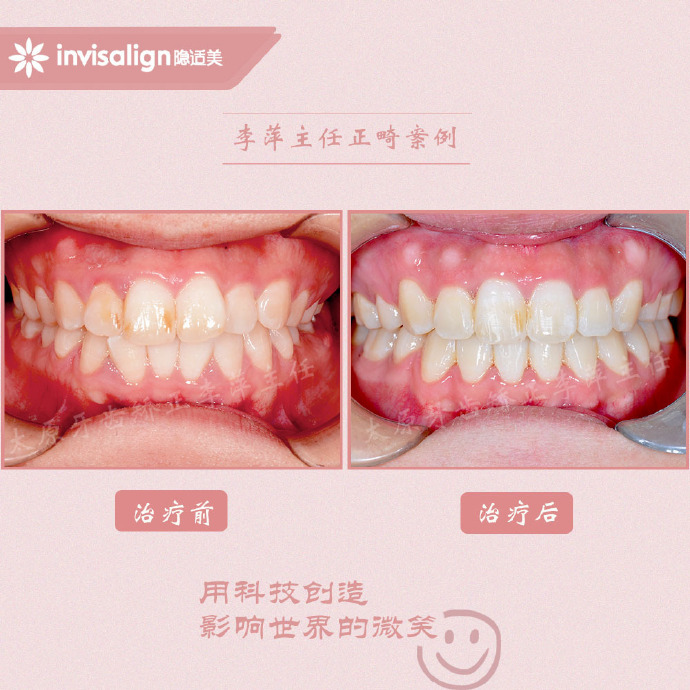 太原牙齿矫正拔牙拔六颗有危害吗,太原牙齿开合矫正