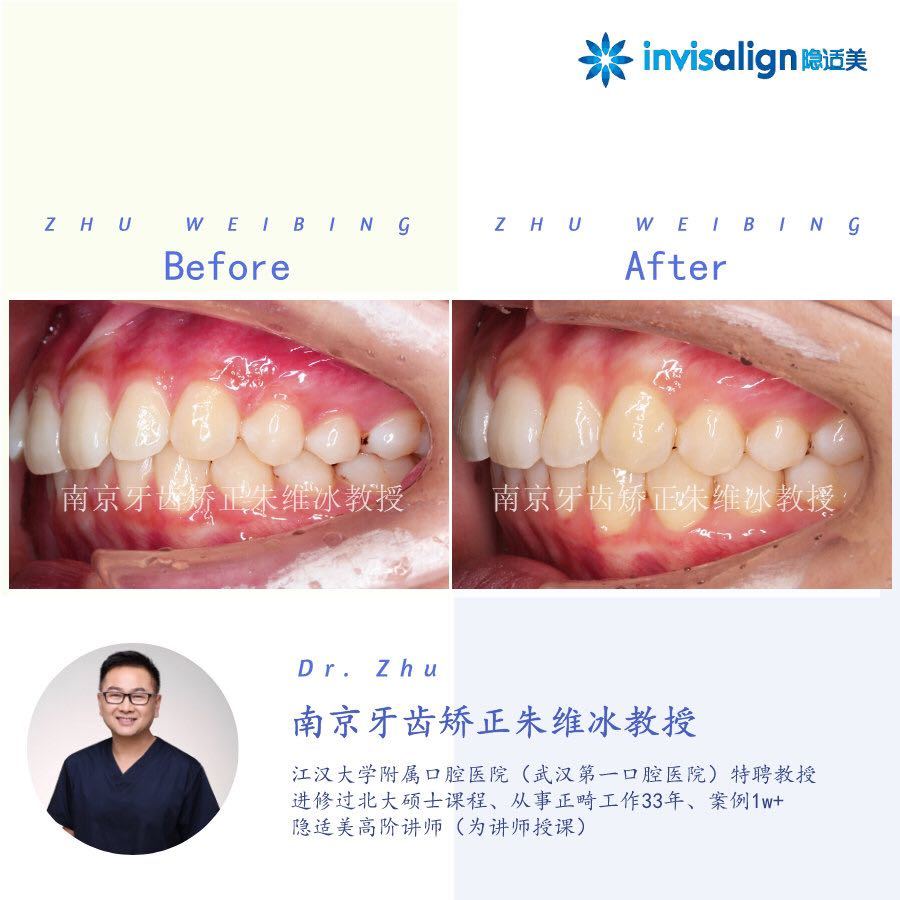 南京口腔医院矫正一颗牙齿多少钱,大医院为啥不建议做牙齿矫正