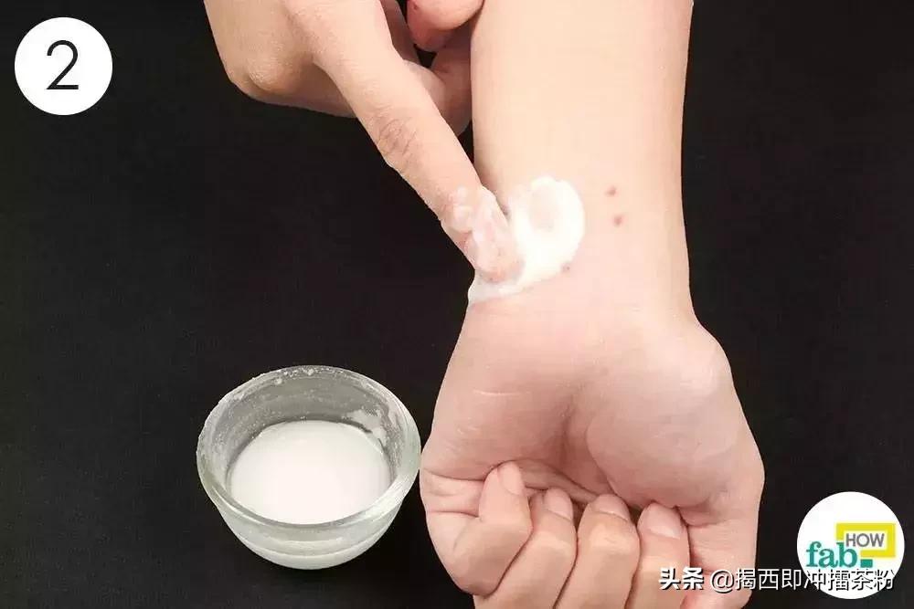 被蚊子咬了但是没有风油精怎么办,被蚊子咬了又没有药怎么办