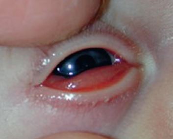 宝宝眼睛红是红眼病吗,新生宝宝眼睛红