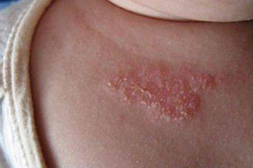 宝宝湿疹反反复复，妈妈应当怎样做呢？