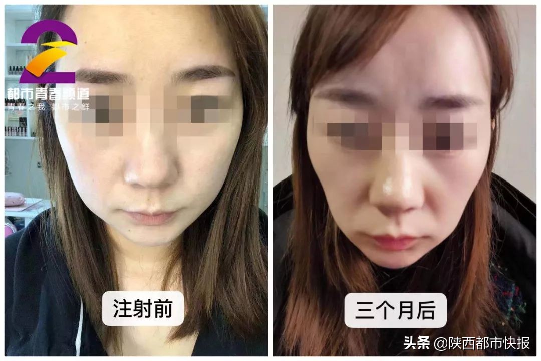 可怕！两女子6年交情“一针”终结！西安女孩瘦脸不成“脸塌了”