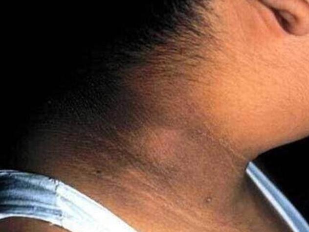 13岁孩子脖子周围黑洗不掉,六岁女童脖子发黑