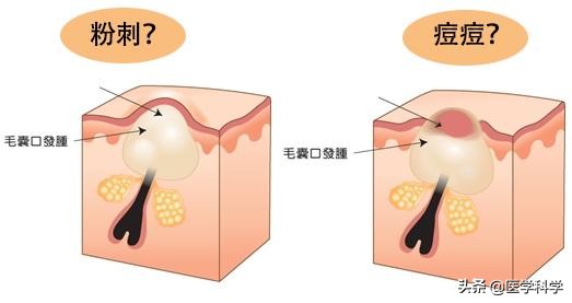 闭口粉刺怎么祛除妊娠纹,闭口粉刺怎么去除用什么护肤品