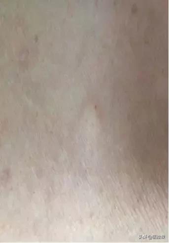 护理学注射法名词解释,基础护理学注射法视频