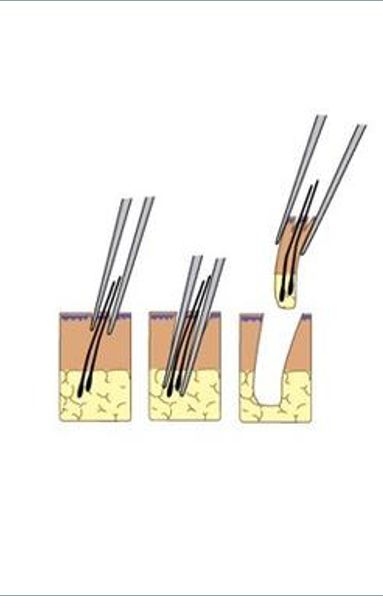 头发种植手术是如何种植的,头发种植利弊有哪些呢