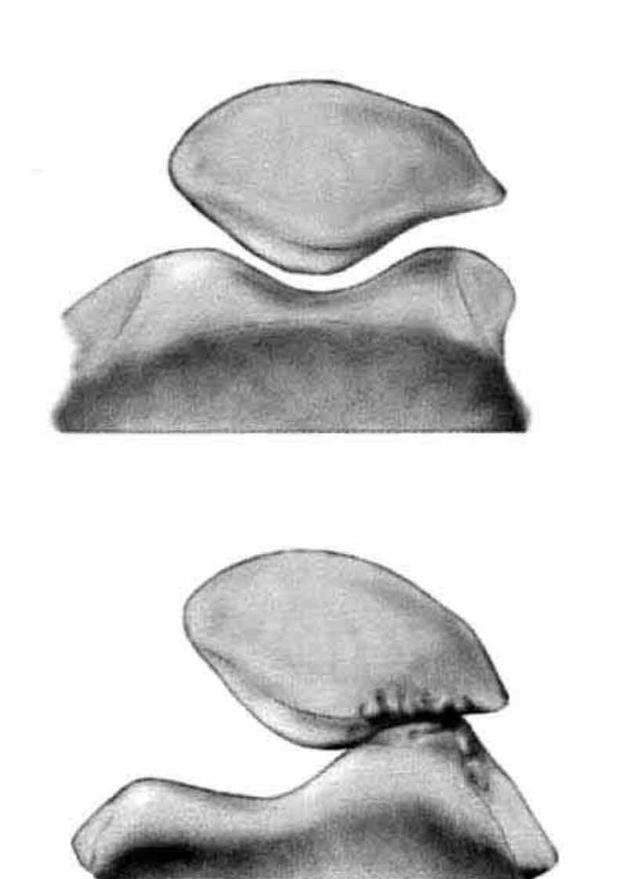 爬楼梯膝盖吃力怎么回事,爬楼梯太多膝盖疼怎么缓解
