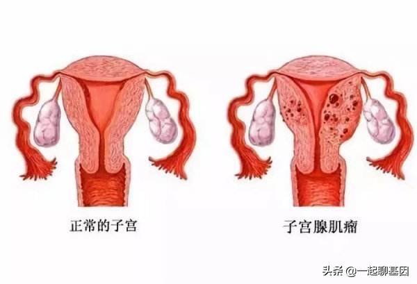 子宫肌瘤是怎么回事,子宫肌瘤为什么医生都不开药治疗
