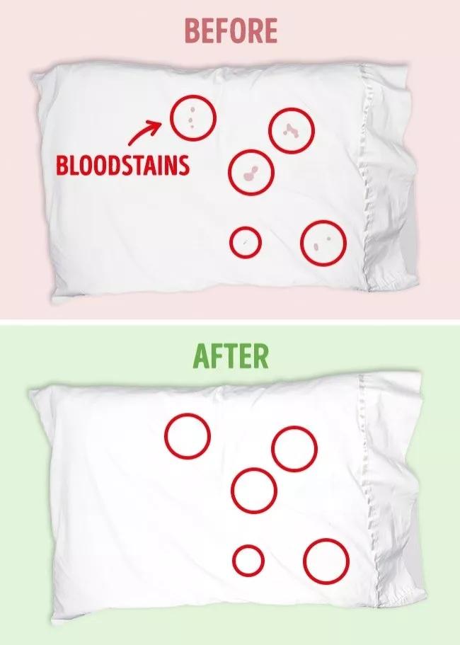 名门泽佳去眼袋红肿结痂图片,名门泽佳去眼袋效果怎么样