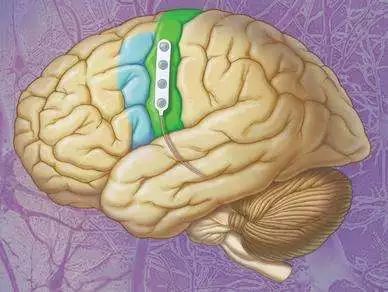 神经元修复治疗癫痫最近进展,癫痫治疗新方法神经调控治疗