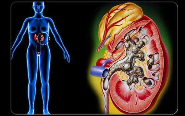 结石的痛真叫人刻骨铭心,结石比什么病都难受