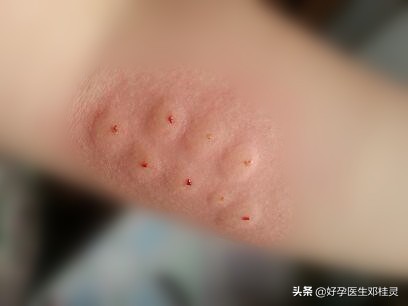 复发性流产患者胎停的概率,导致复发性流产的原因有哪些