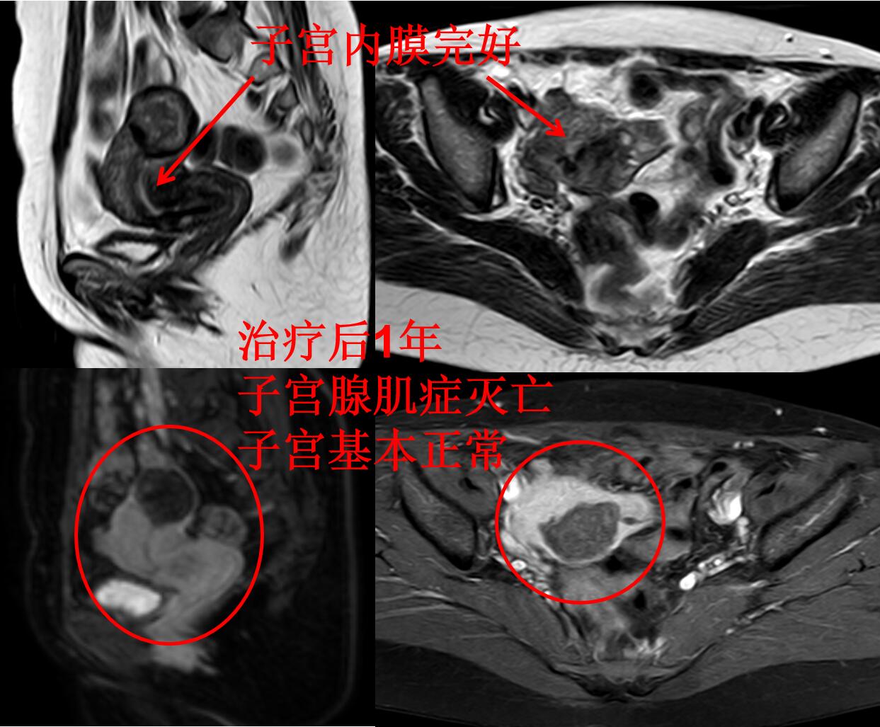看看痛不欲生的子宫腺肌症痛经专业领域的看法与典型病例