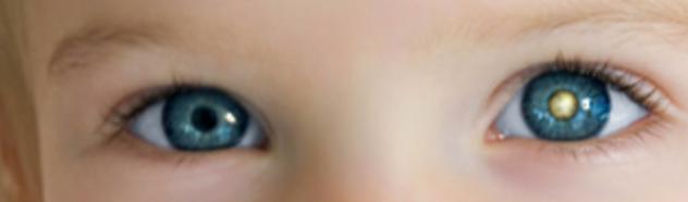 视网膜母细胞瘤6个月大的婴儿,视网膜母细胞瘤猫眼