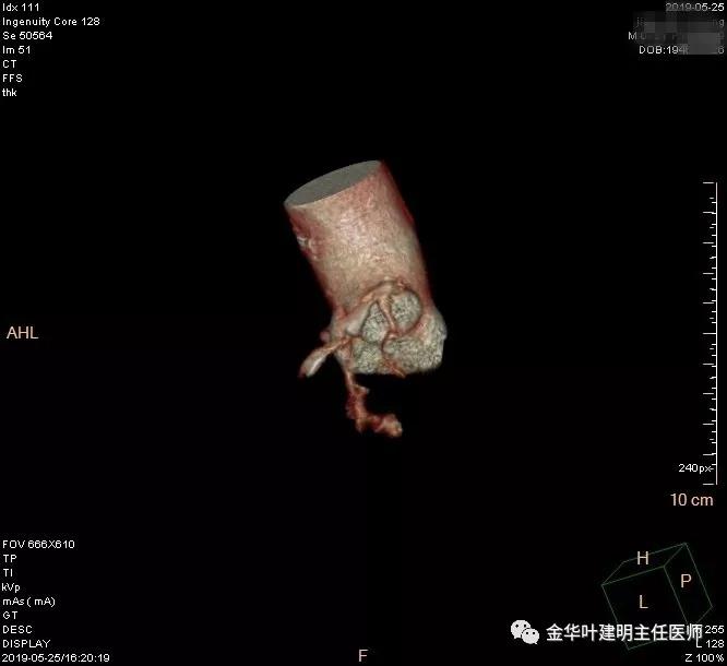 手术引起乳糜胸,有没有做了肺结节手术后是误诊的