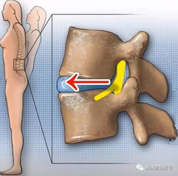 72岁老人腰疼还有骨刺该怎么治疗,老年人骨刺疼痛怎么治疗