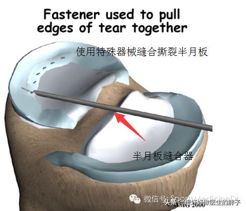 半月板损伤通常是单膝还是双膝,你知道半月板是什么吗