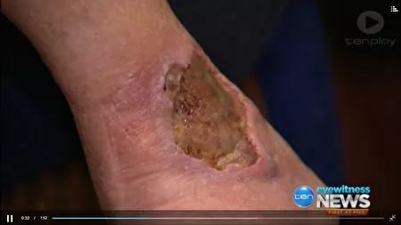 紧急！全澳多地出现“吃人菌”，感染后如同丧尸！24小时可吃一人