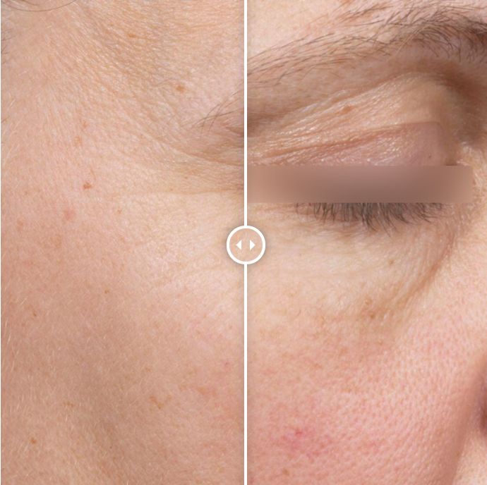 挤压导致的毛孔粗大是不可逆的吗,挤黑头后的毛孔粗大是不可逆的吗