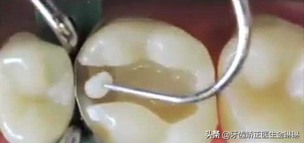蛀牙补牙了材料老是会掉,补牙材料容易掉怎么回事