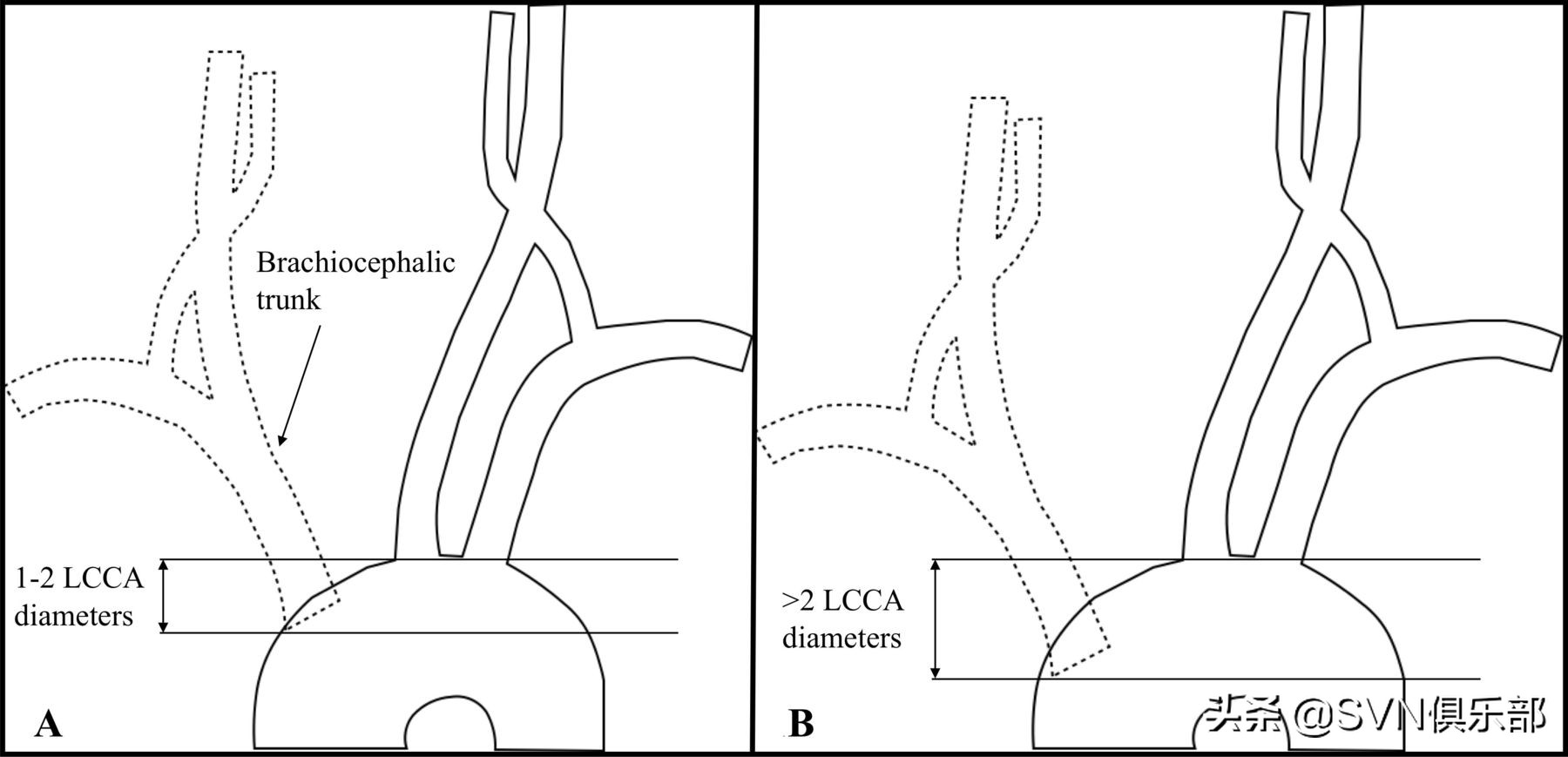 出版简讯｜直接颈动脉穿刺治疗急性缺血性卒中