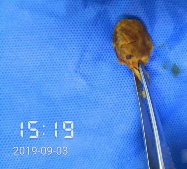 阑尾炎形成窦道的原因,阑尾炎一孔微创手术全过程