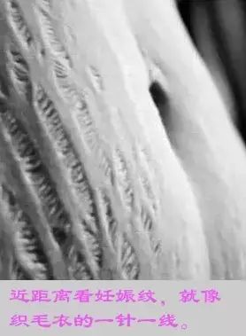 产后妊娠纹怎么去除,产后祛除妊娠纹最有效的方法