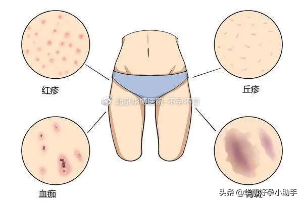 皮肤瘙痒起疙瘩抓出现血斑,皮疹痒挠多了有淤血