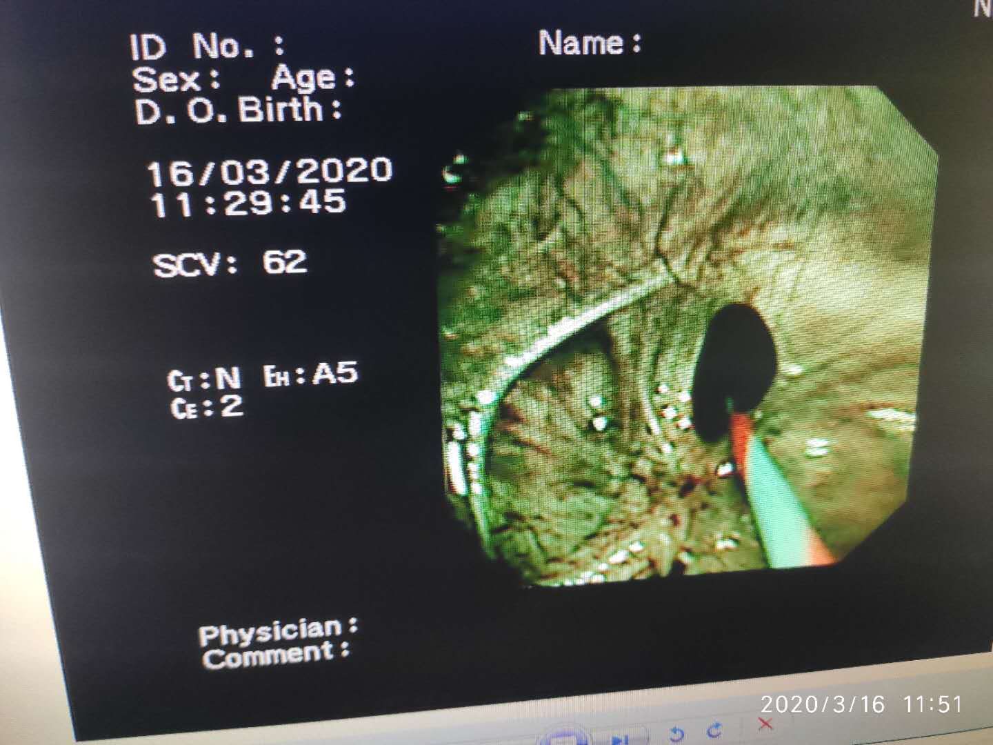 经支气管镜球囊扩张治疗气道狭窄,支气管镜球囊扩张操作视频