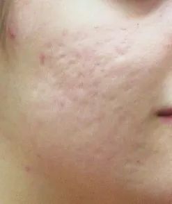 什么可以去除暗红色痘印痘坑,红痘印与黑痘印的消除方法