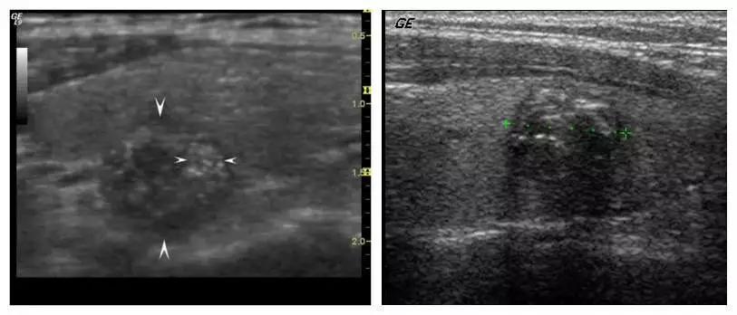 甲状腺彩超报告有钙化怎么办?!