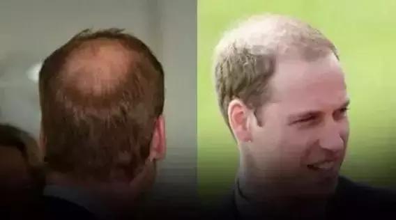 秃了怎么拯救,秃头已成世界第二大难题