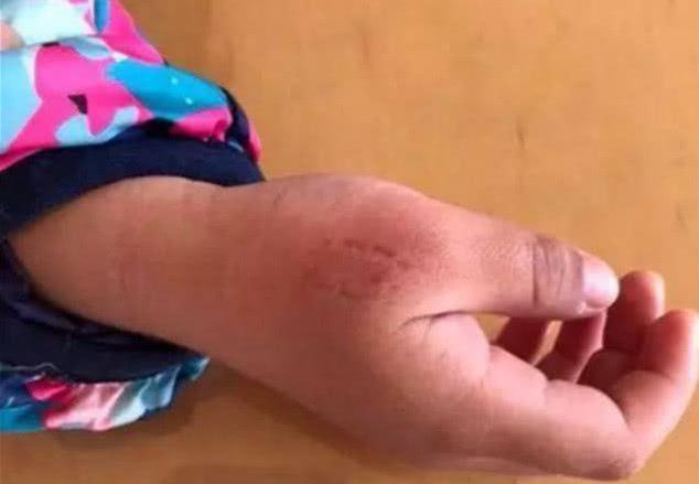 小孩在幼儿园被小朋友咬伤,孩子在幼儿园被其他小孩咬伤