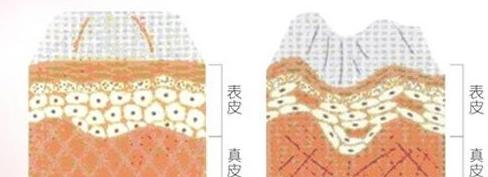 线雕是面部提升最好的方法吗,面部提升最好的方法是线雕吗