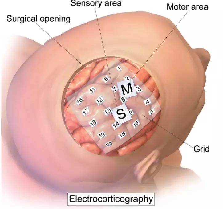 马斯克谈超级智能,马斯克公司公布猴子用意念玩游戏