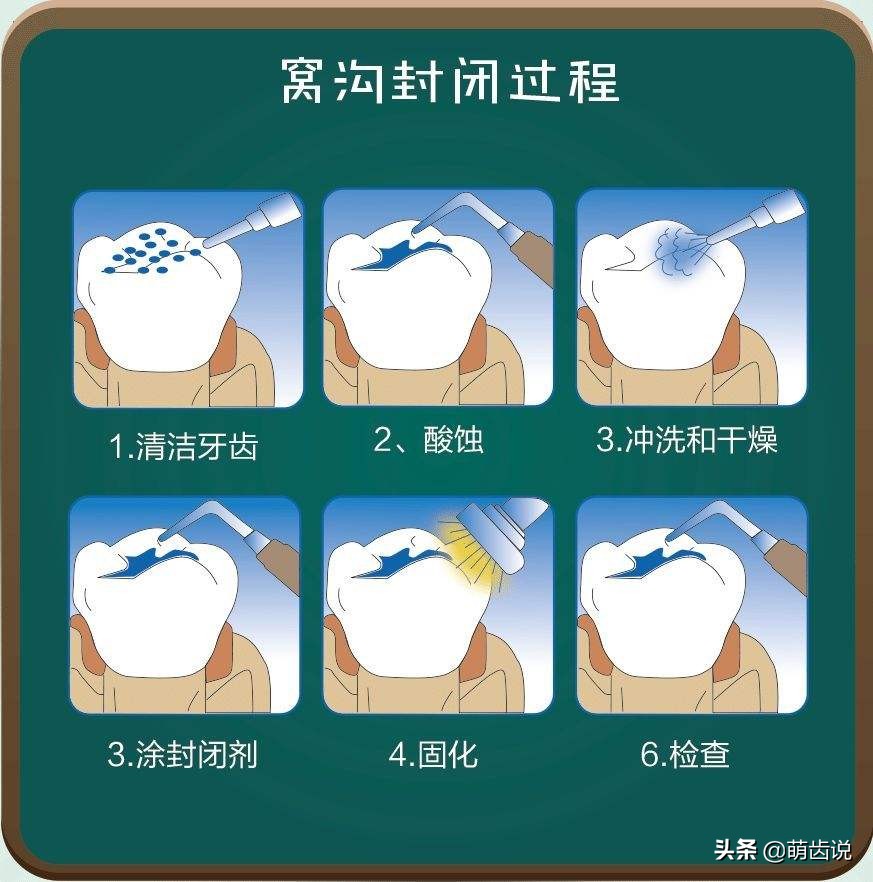 宝宝六龄牙怎么保护,六岁孩子牙做什么保护