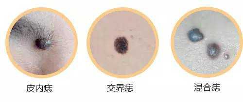 中医院点痣方法,中医治疗点痣