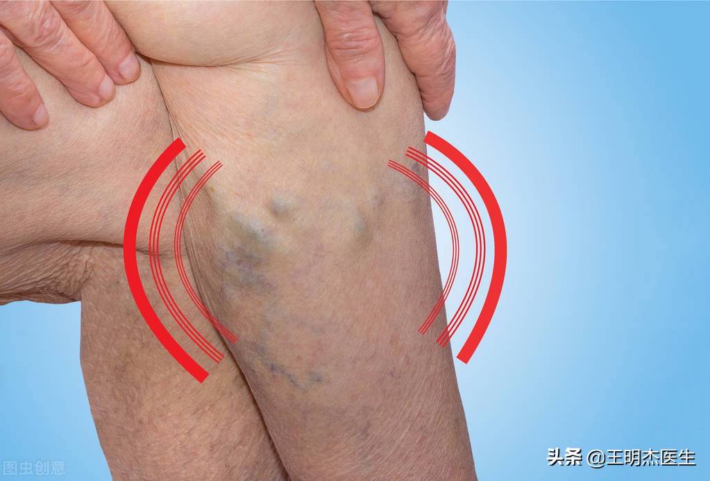 下肢静脉曲张溃疡了怎么办,如何治疗下肢静脉曲张溃疡发黑