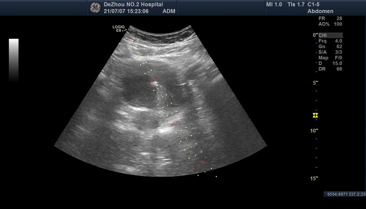 卵巢畸胎瘤和巧克力囊肿,未婚女性卵巢巧克力囊肿