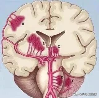体检查出腔隙性脑梗塞严重吗,体检查出腔隙性脑梗怎么办