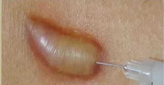 鼻子打疤痕软化针疼吗,打疤痕软化针注意事项