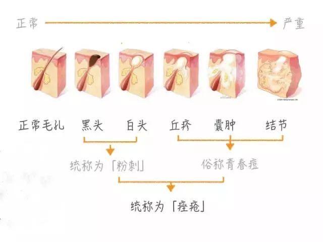 挤闭口粉刺有效吗,挤下巴闭口粉刺