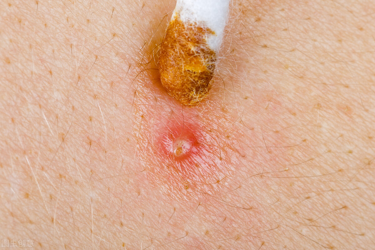 毛囊炎最好的内服药排名,有治疗毛囊炎的特效药吗