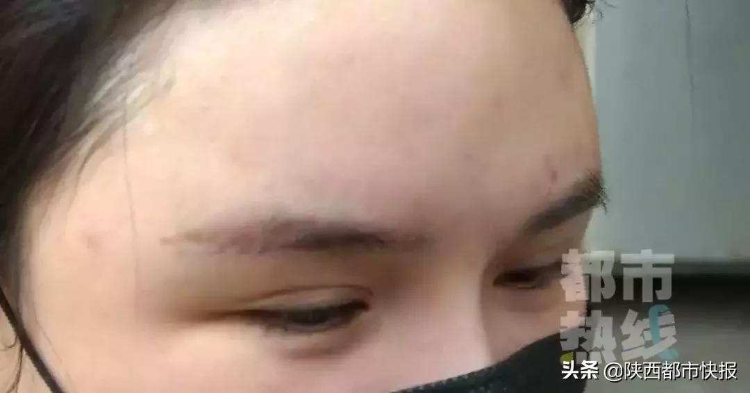 女子打童颜针修复,一女子打瘦脸针毁容